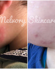 Mozzie Balm